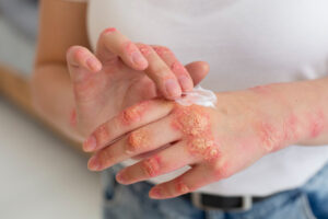 Psoriasis : comprendre cette affection cutanée et adopter une routine de soin adaptée